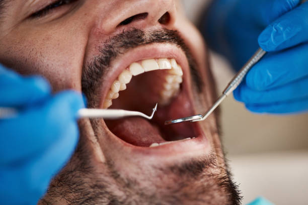 Best Emergency Dentist for Lost Fillings or Crowns in Rapid City, SD